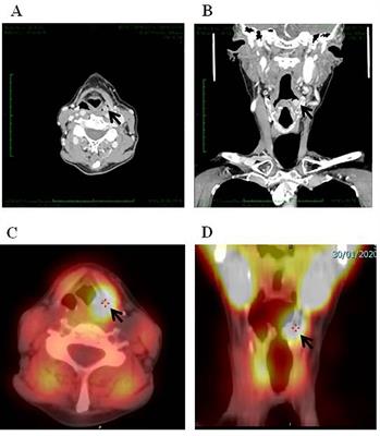 Persistent primary hyperparathyroidism caused by an ectopic adenoma in the piriform sinus: case report and review of the literature